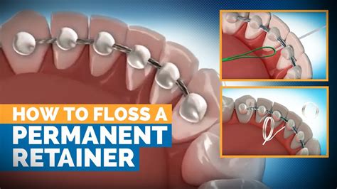 The Benefits And Care Of A Permanent Retainer