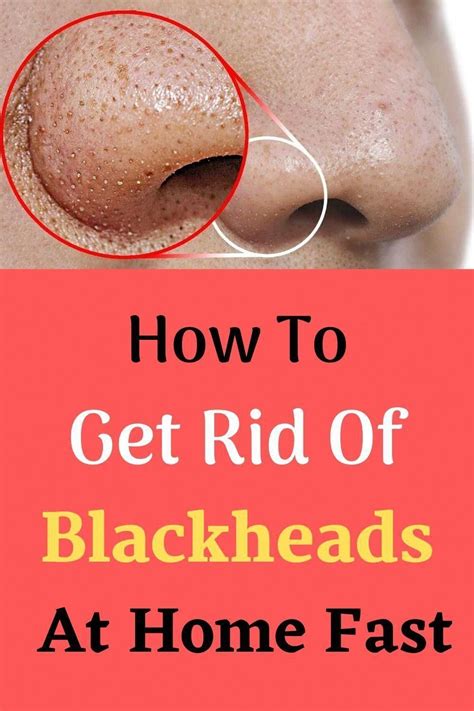 Get Rid Of Blackheads On Nose Artofit