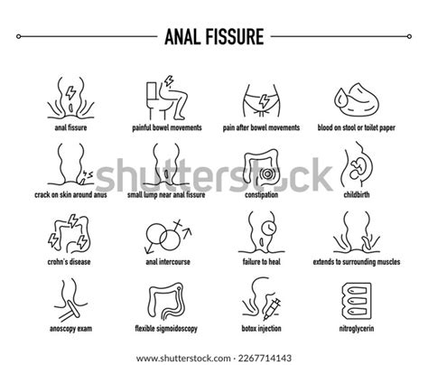 Anal Fissure Symptoms Diagnostic Treatment Vector Stock Vector Royalty Free 2267714143