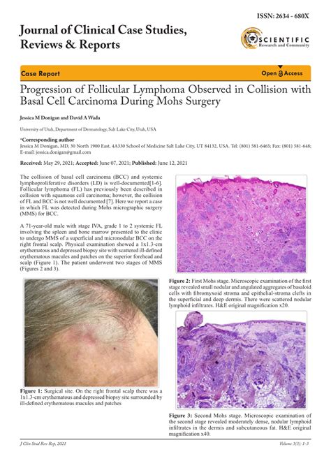 Pdf Progression Of Follicular Lymphoma Observed In Collision With