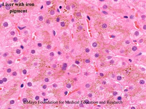 Hemochromatosis - Mayo Clinic Proceedings