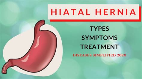 hiatal hernia after baby - Lucie Peak