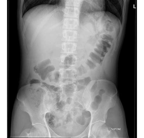 Lupus nephritis chest x ray - wikidoc