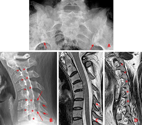 Ankylosing Spondylitis Mri Si Joint