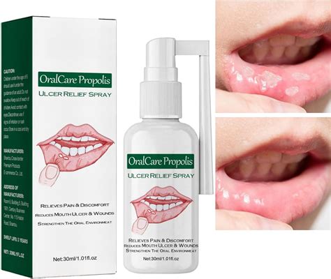 Mouth Ulcer Treatment Spray Mouth Ulcer Spray Canker Sore Treatment For Adults Oralcare Propolis