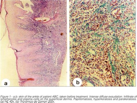 Scielo Brasil Histopathology Of Human American Cutaneous