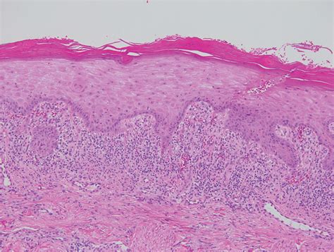 Diffuse Papular Eruption With Erosions And Ulcerations Mdedge Dermatology