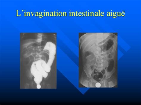 Les Urgences Chirurgicales Du Nourrisson Invagination Intestinale Aigu