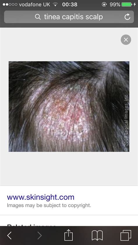 Tinea Capitis Symptoms Grey Bald Patches With Red Outer Ring And Hair Stubble Within The Area