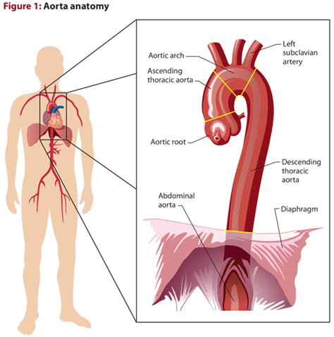 How Aortic Aneurysms Become Aortic Catastrophes Jems Ems Emergency