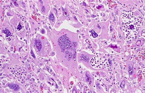 Undifferentiated Pleomorphic Sarcoma Ups With Bizarre Pleomorphism