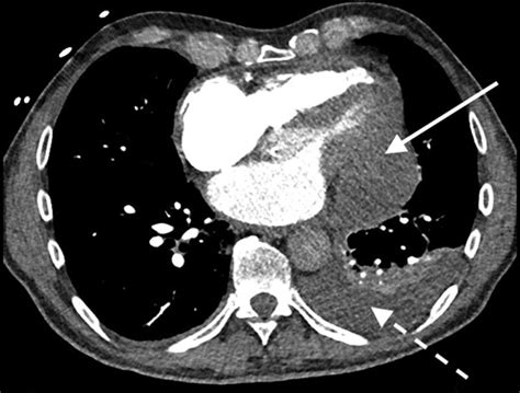 Coronary Artery Perforation Complicated By Pericardial Abscess