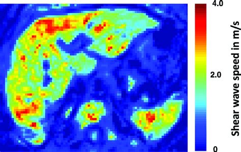 Magnetic Resonance Elastography Mre Of The Liver In A Cirrhotic