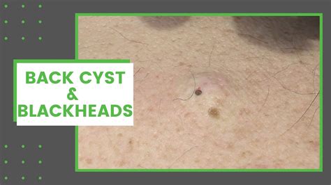 Back Cyst & Blackheads | Dr. Derm - YouTube