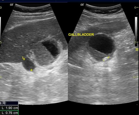 Perforated Gallbladder Ultrasound