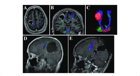 | Merged DTI sequence and contrast T1-weighted MRI revealing the ...