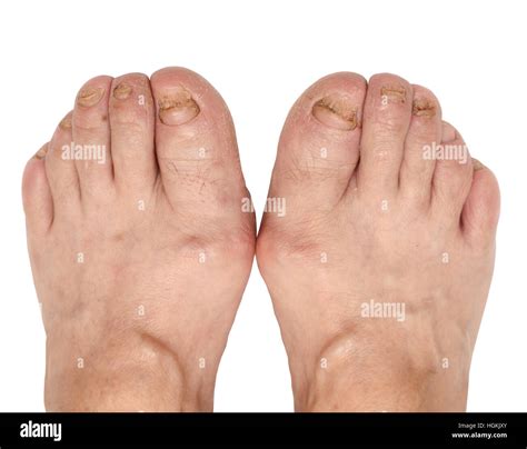 Toenail Fungus At The Peak Of The Infection Stock Photo Alamy