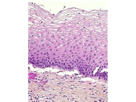 Pathology Outlines Chronic Cervicitis