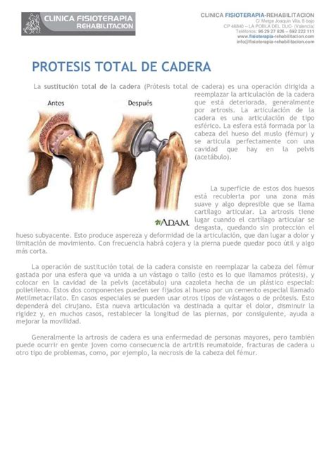 Pdf Protesis De Cadera Cl Nica Fisioterapia Kike Pdf Filela