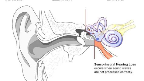 Sensorineural Hearing Loss