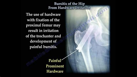 Hip Bursitis From Hardware Irritation Everything You Need To Know Dr Nabil Ebraheim Youtube