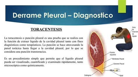 Derrame Pleural Y TEP Caracteristicas Generales PPT Descarga Gratuita