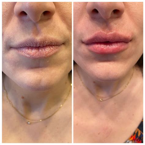 Saggy Lips From Lip Fillers Lipstutorial Org