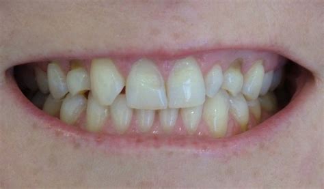 Tooth Bonding And Reshaping Adelaide Cosmetic Dentistry