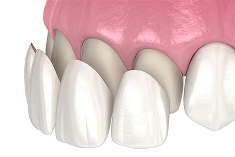 Composite Teeth Bonding and Filling – Everything You Need to Know ...