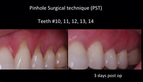 Chao Pinhole Surgical Technique Gets The Nod Rick Glassman Dds Maafe