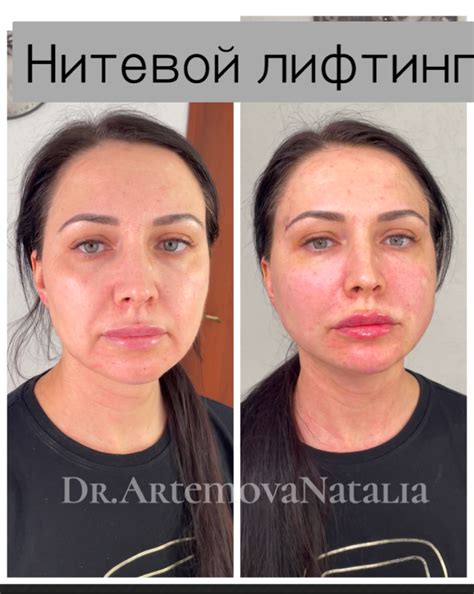 Нитевой Лифтинг в Новосибирске | Косметологическая Клиника ARTmed Clinic