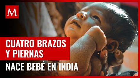 Reportan Nacimiento De Beb Con Cuatro Brazos Y Piernas En India Youtube