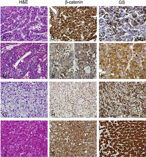 Histological Patterns And B Catenin And Glutamine Synthetase Gs Download Scientific Diagram