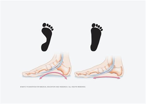 Can A Podiatrist Fix Flat Feet Head 2 Toe