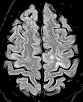 Imaging Of Intracranial Infectious Diseases In Adults Applied Radiology