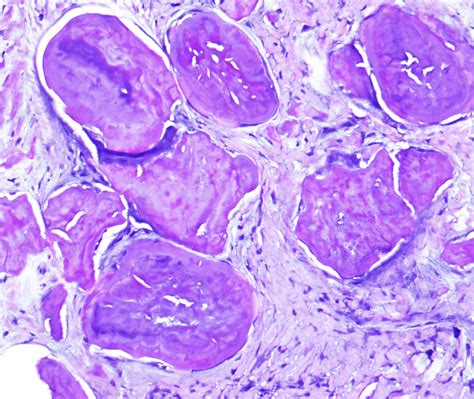 Nodular Amyloidosis Associated With Scleroderma Dermatopathology