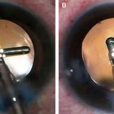 anterior capsular tear in a case of FlaCs. Notes: (A) Polishing of ...