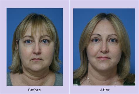 This Patient Underwent A Facelift Buccal Lipectomy And Upper