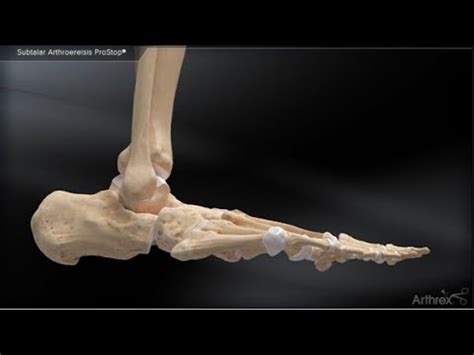 Subtalar Arthroereisis ProStop YouTube