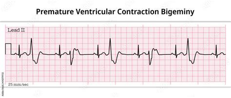 Premature Ventricular Contraction Ecg