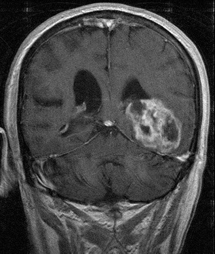 Glioblastoma Multiforme RadioGraphics