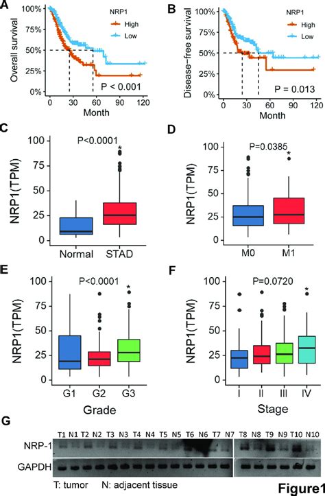 Nrp Highly Expressed In Gastric Cancer And Predicts Poor Prognosis