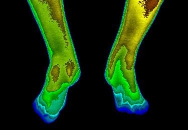 Using Infrared Imaging Before And After Shows Firefly Light Therapy