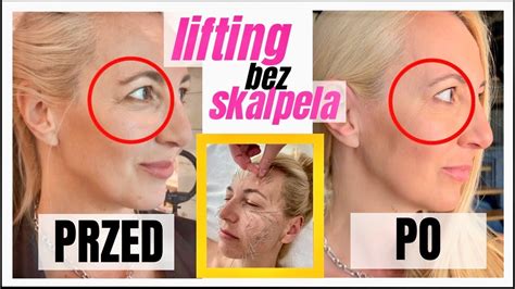 LIFTING BEZ SKALPELA TO DZIAŁA WIDOCZNE EFEKTY YouTube