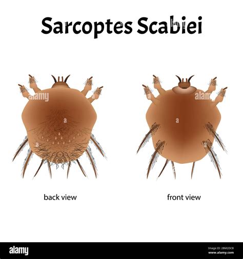 Sarcoptes Scabiei Scabies Sexually Transmitted Disease Infographics Illustration On Isolated