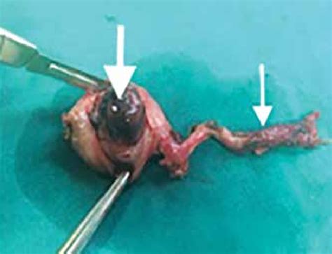 C Morphological Examination Of The Rudimentary Horn Pregnancy After