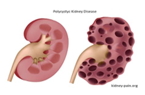 Nephrosis Disease