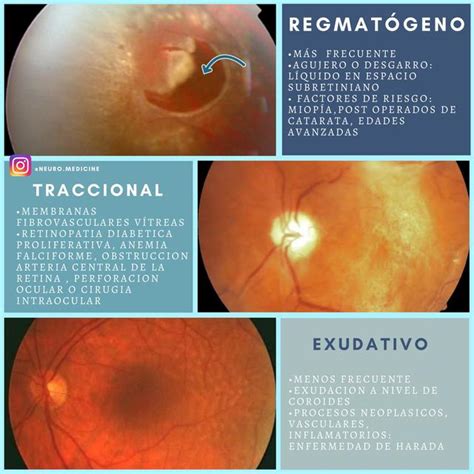 Desprendimiento De Retina NeuroMedicine UDocz