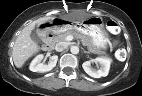 Gastrointestinal Stromal Tumor Role Of Ct In Diagnosis And In Response