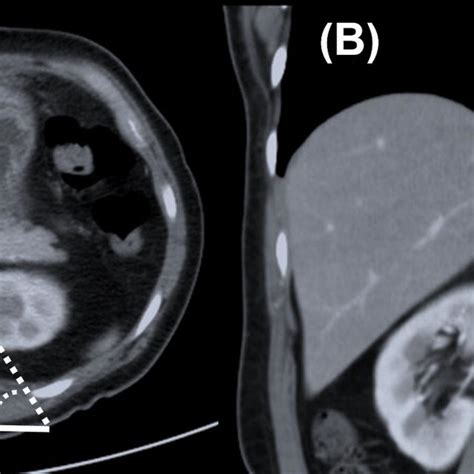 Position And Trocar Placement For Laparoscopic Right Adrenalectomy